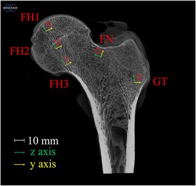 Mechanical impact of regional structural deterioration and tissue-level compensation on proximal femur trabecular bone